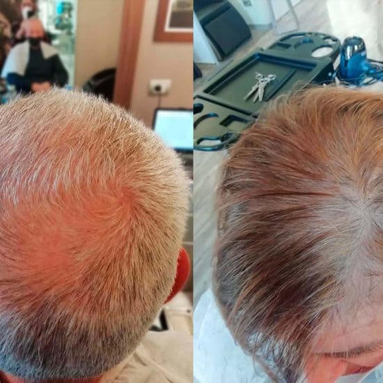 diradamento dei capelli
